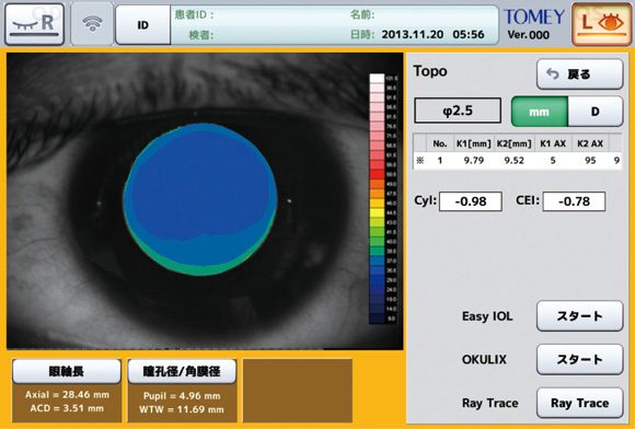 角膜トポグラフィー（角膜形状解析）